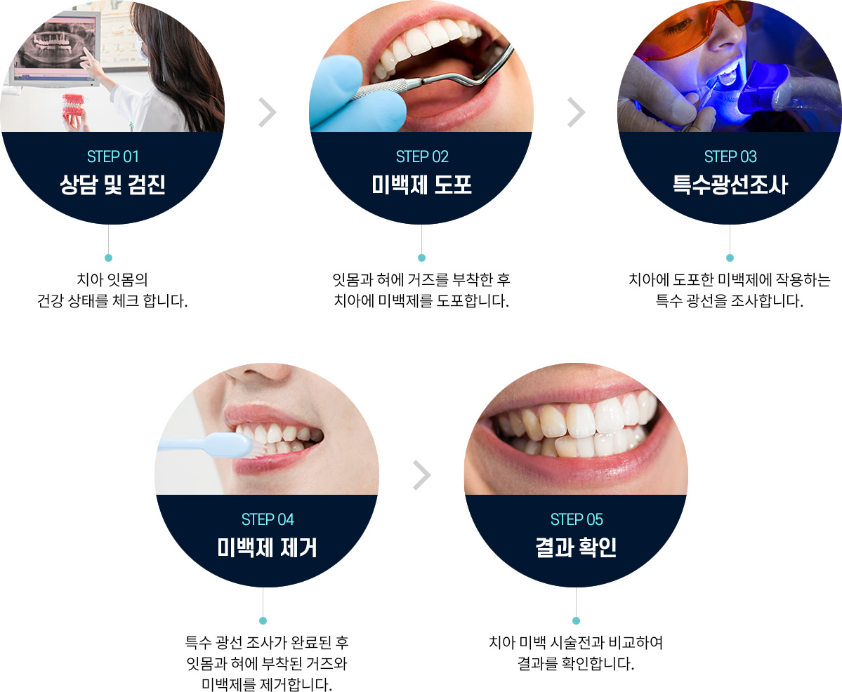 STEP 01 상담 및 검진(치아 잇몸의 건강 상태를 체크합니다.) > STEP 02 미백제 도포(잇몸과 혀에 거즈를 부착한 후 치아에 미백제를 도포합니다.) > STEP 03 특수광선조사(치아에 도포한 미백제에 작용하는 특수 광선을 조사합니다.) > STEP 04 미백제 제거(특수 광선 조사가 완료된 후 잇몸과 혀에 부착된 거즈와 미백제를 제거합니다.) > STEP 05 결과 확인(치아 미백 시술 전과 비교하여 결과를 확인합니다.)