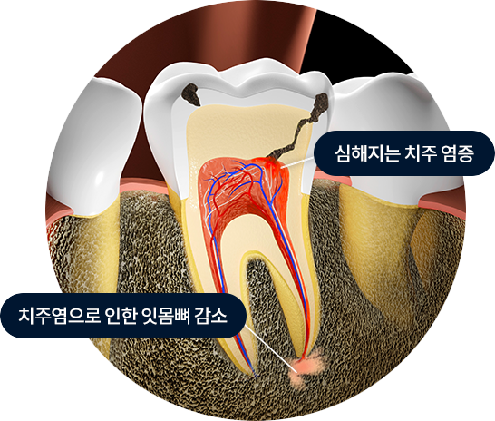 심해지는 치주 염증 / 치주염으로 인한 잇몸뼈 감소