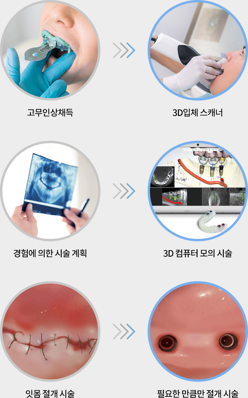 고무인상채득 >>> 3D 입체 스캐너 / 경험에 의한 시술 계획 >>> 3D 컴퓨터 모의 시술 / 잇몸 절개 시술 >>> 필요한 만큼만 절개 시술